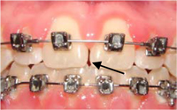 Space Between Teeth